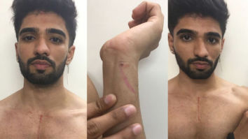 Zeeshan Khan shares pictures of his bruised body post his eviction from Bigg Boss OTT