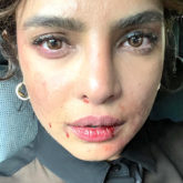 Priyanka Chopra shares a photo with a bruised face; here is how fans reacted to it