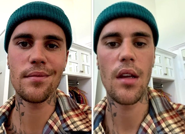 Justin Bieber suffering from partial face paralysis caused by Ramsay Hunt Syndrome - 