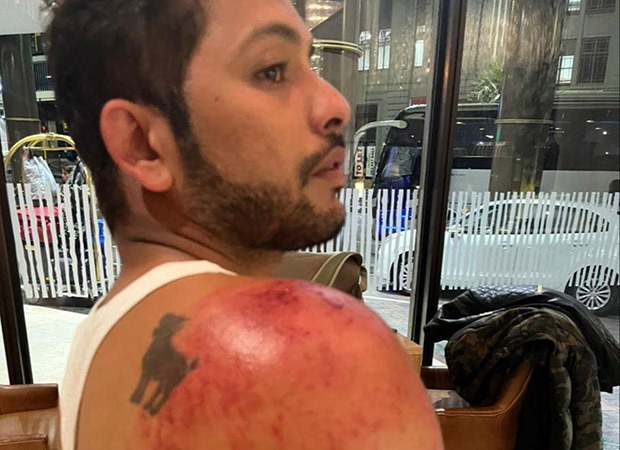 Khatron Ke Khiladi 12: Nishant Bhat suffers major injuries while performing the tasks on the reality show